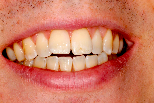 Before Invisalign - Atlanta, GA