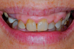 Before Porcelain crowns, gum lift, and Invisalign