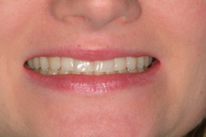 before cosmetic bonding - 6 teeth