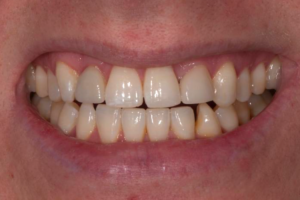 Before Invisalign and Porcelain Crown - Cosmetic Dentistry of Atlanta