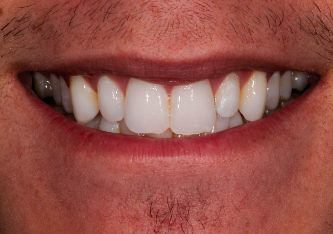 Before - Prepless Veneers