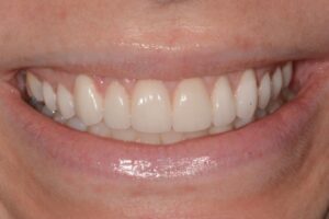 Invisalign, Veneers and Gum Lift - after surgery