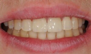 beautiful crowns - cosmetic dentistry - after photo