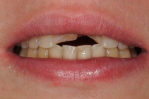 beautiful crowns - cosmetic dentistry - before photo
