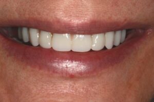 after implant crowns
