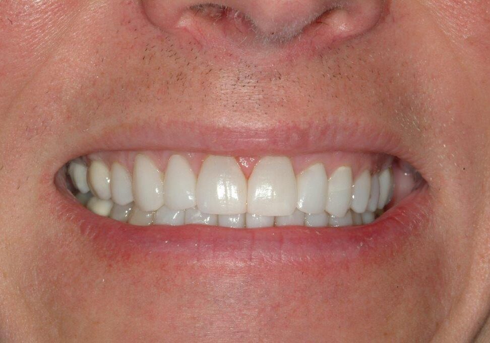 after veneers and dental crowns