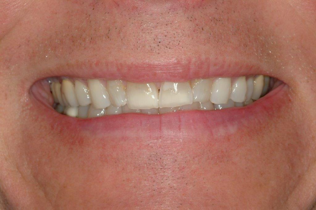 before veneers and dental crowns