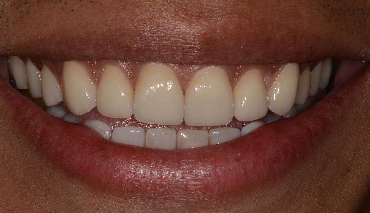 MB-after