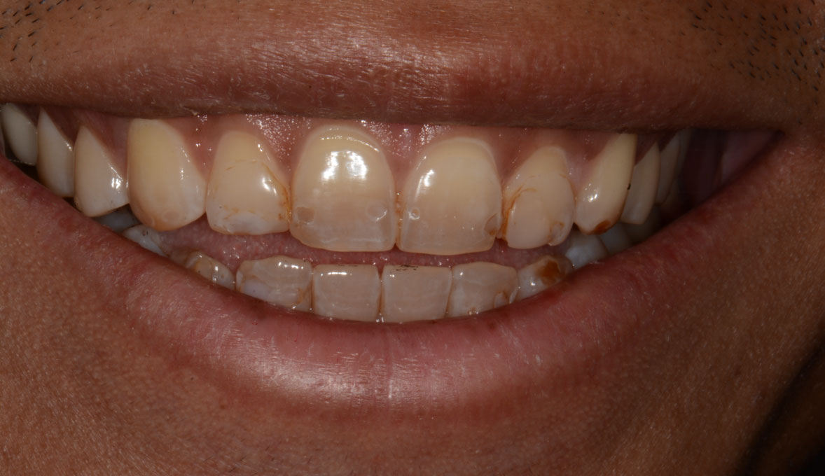 MB-before