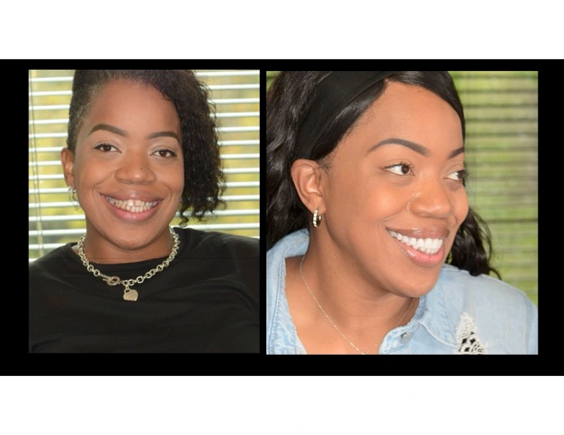 Real patient before and after photos from no prep veneers