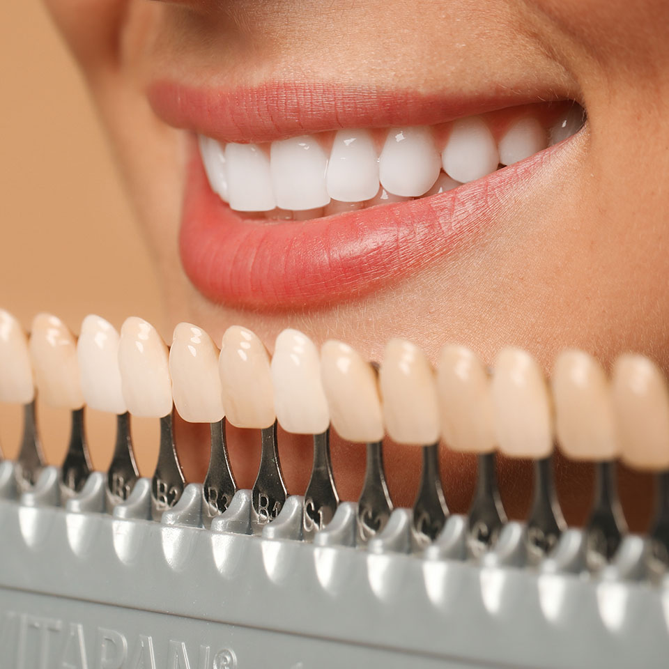 Close-up of a smiling person’s teeth with a tooth shade guide held in front, showing various shades used to match or select dental veneers or crowns.