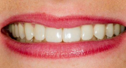 Patient after bonding procedure