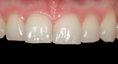 Patient before bonding procedure