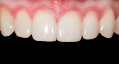 Patient after bonding procedure