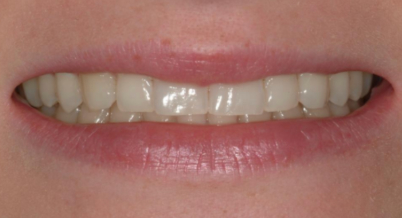 Patient before bonding procedure