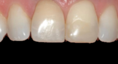 Patient before bonding procedure