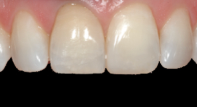 Patient after bonding procedure