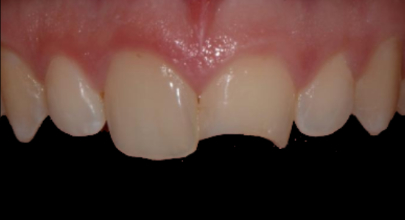 Patient before bonding procedure