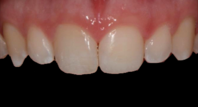 Patient after bonding procedure