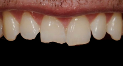 Patient before bonding procedure