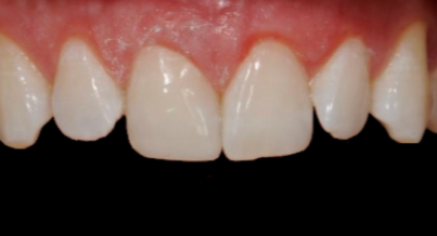 Patient after bonding procedure