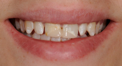 Patient before veneers procedure