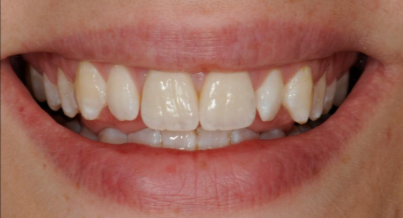 Patient after veneers procedure