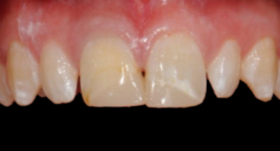 Patient before veneers procedure