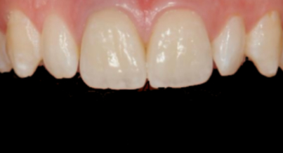 Patient after veneers procedure