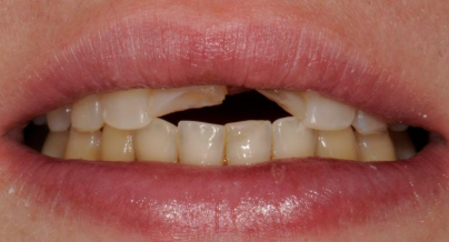 Patient before veneers procedure