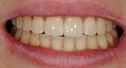 Patient after veneers procedure