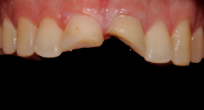 Patient before veneers procedure