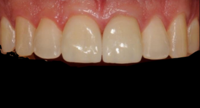 Patient after veneers procedure
