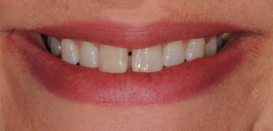 patients before full mouth rehabilitation