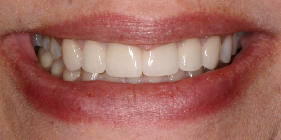 patients after full mouth rehabilitation
