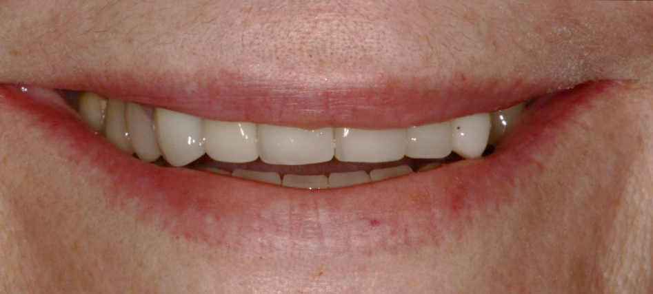 patients before full mouth rehabilitation
