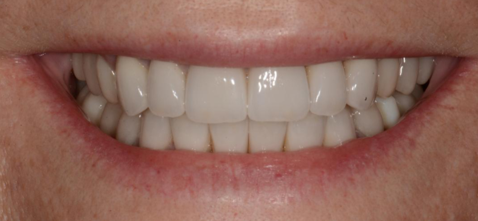 patients after full mouth rehabilitation