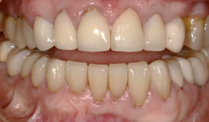 patients after full mouth rehabilitation