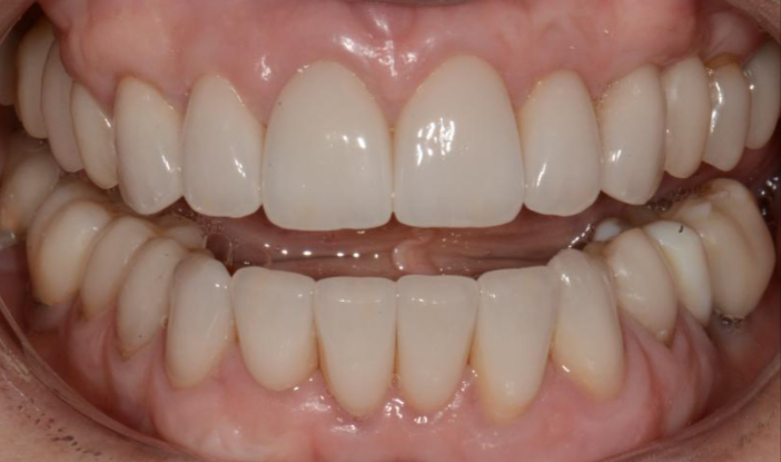 patients after full mouth rehabilitation