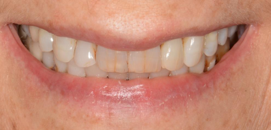 patients before full mouth rehabilitation