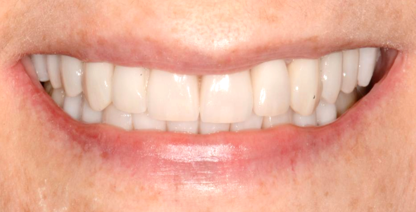 patients after full mouth rehabilitation