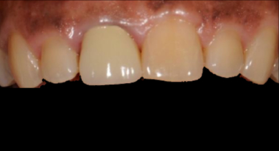 Patient before veneers procedure