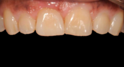 Patient after implant procedure