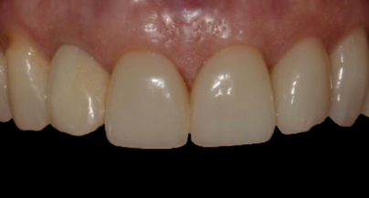 Patient before veneers procedure