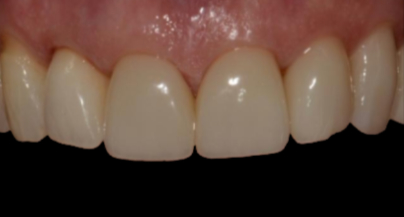 Patient after veneers procedure