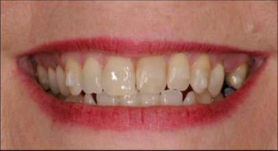 Patient before Invisalign procedure