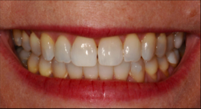 Patient after Invisalign procedure