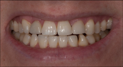Patient before Invisalign procedure