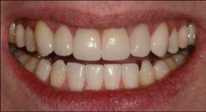 Patient after Invisalign procedure
