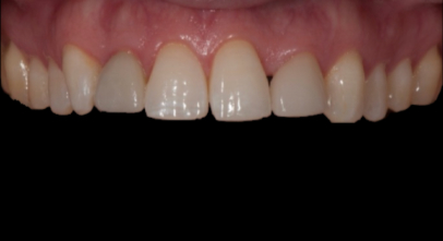 Patient before Invisalign procedure